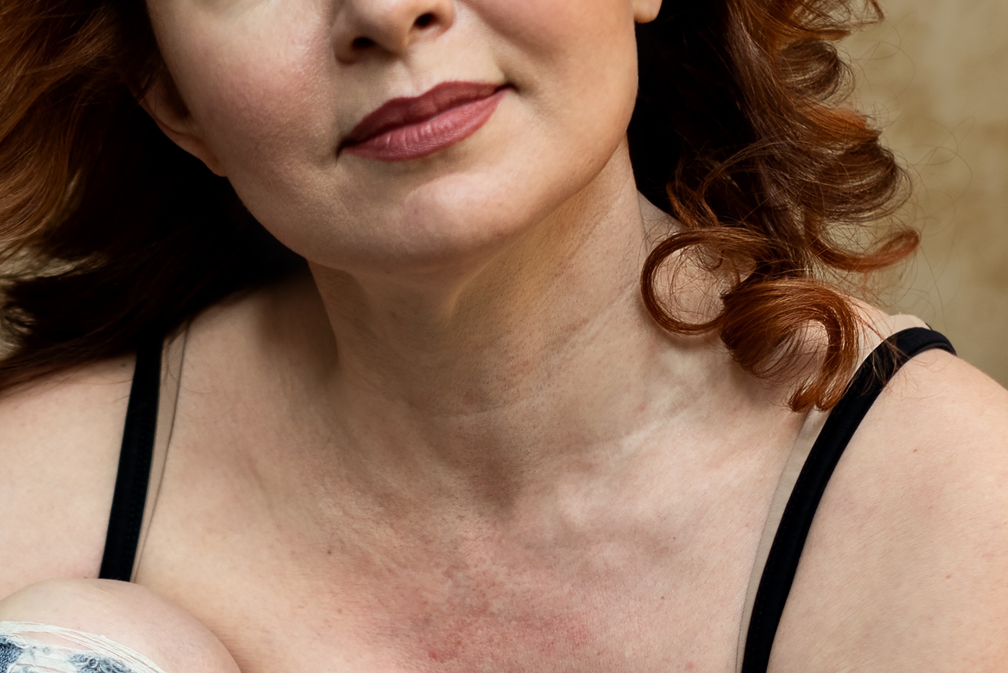 Close up of woman breast and neck with red pigmented skin and wrinkles